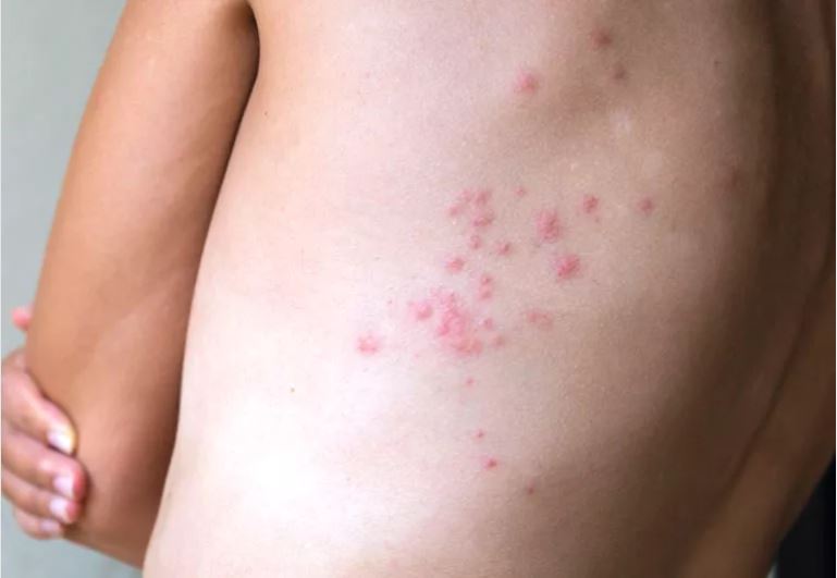 A person's torso shows multiple red, inflamed bite marks clustered on their skin, likely from bed bug bites.